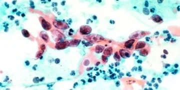 Бактериальный вагиноз – Медсовет Люберцы